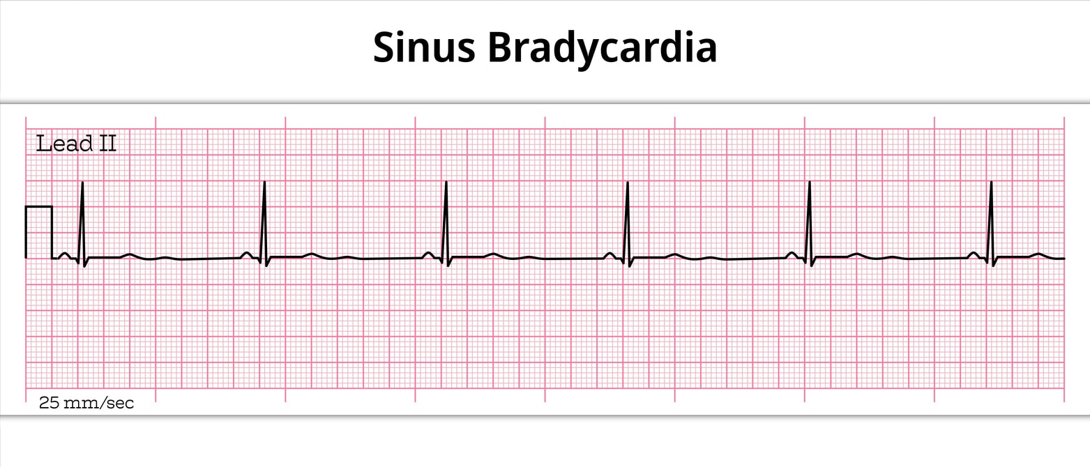 Bradycardia acls algorithm