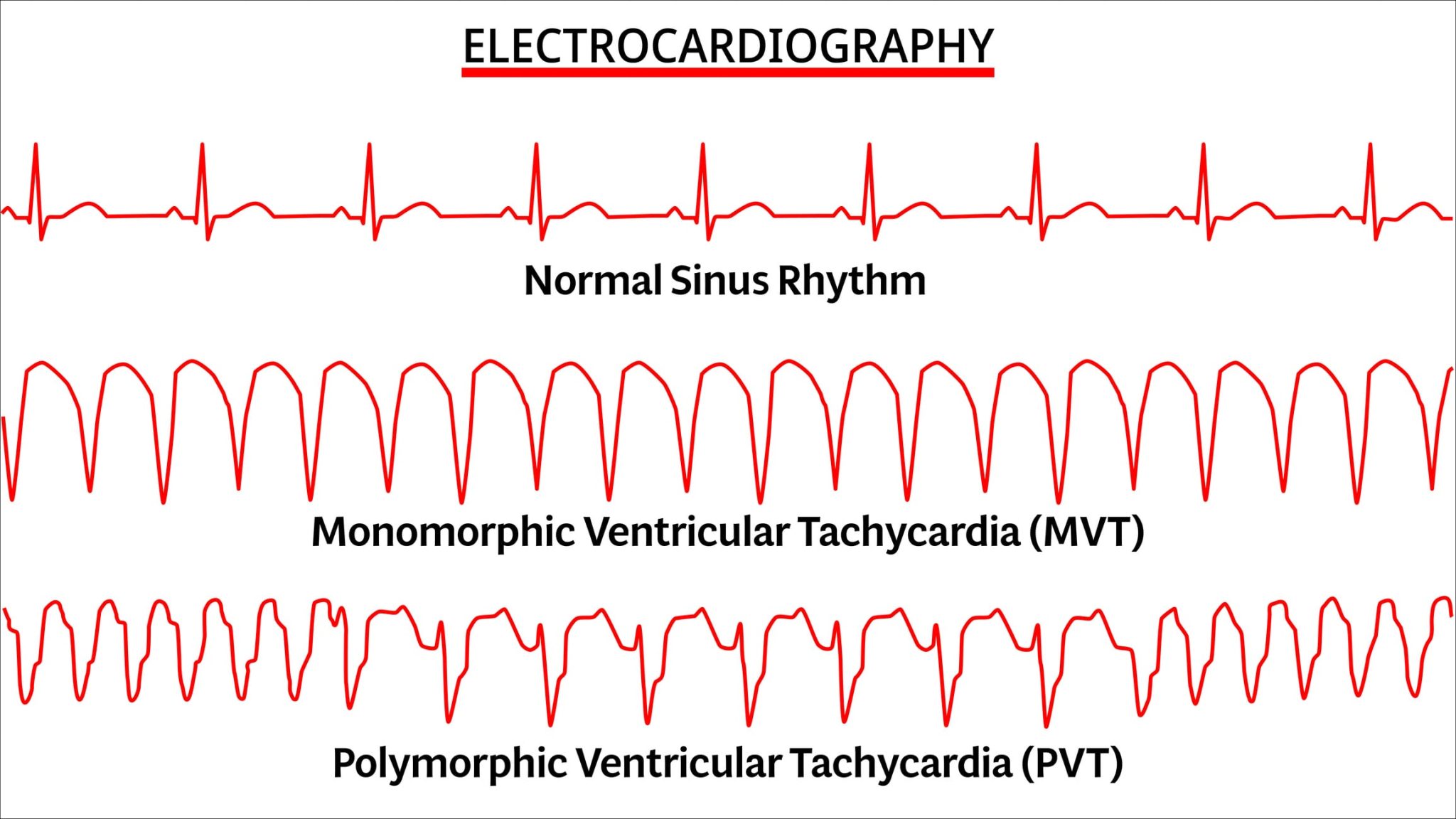 Tachycardia ACLS Algorithm